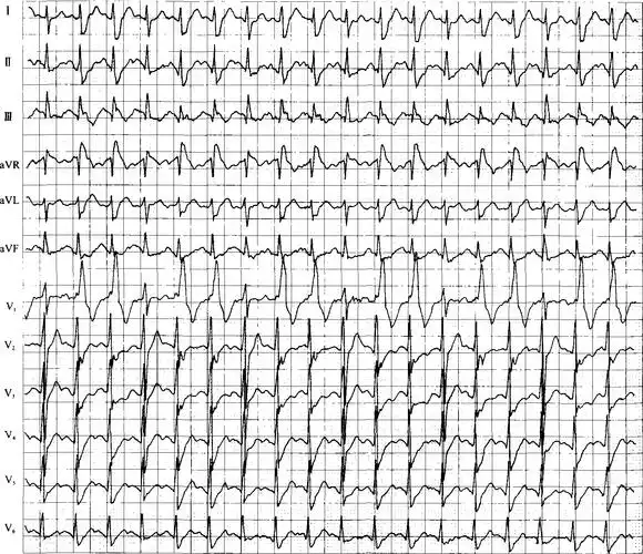 3-3 活动平板运动试验诱发3:2右束支传导阻滞