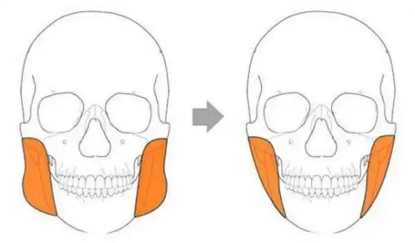 什么是咬肌求图片
