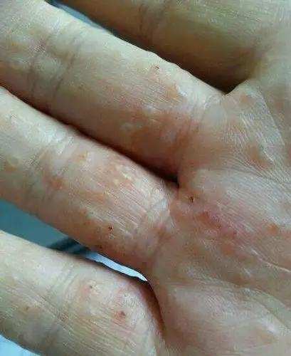 汗疱疹为皮肤科经常见的疾病,又称出汗不良,中医称