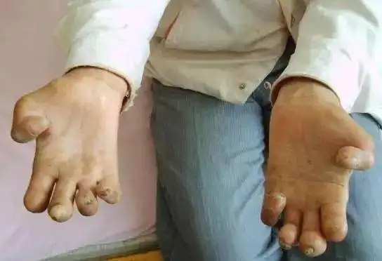 【微科普】创造一个没有麻风的世界,关键在于......