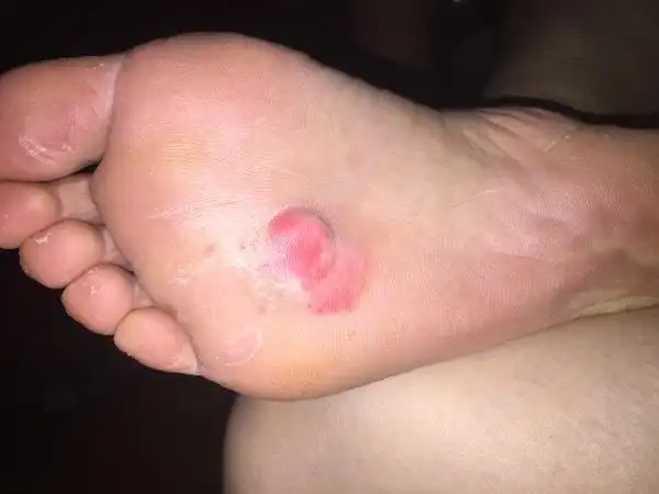 脚掌起了个水泡 不知道是什么东西 以为是鸡眼 求帮助 看看这是什么症