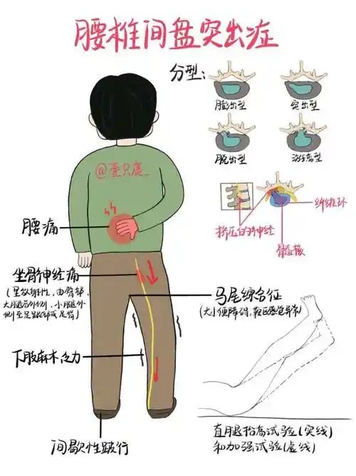 图片发自160app通常情况下,腰椎间盘突出症可以通过保守治疗的方法