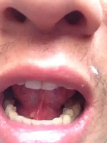 舌头下面长的是什么?白色的伴有肿大,有点疼痛.该怎么治疗?