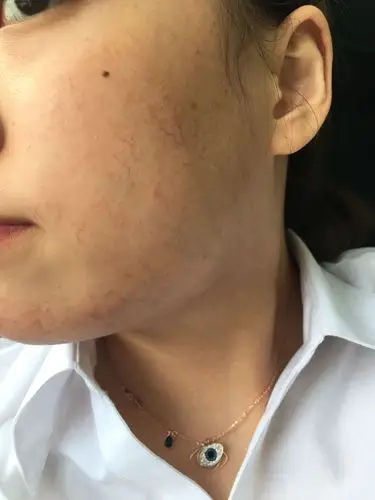 我脸上红血丝有没有办法治