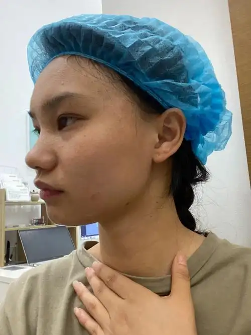 分享一下打完玻尿酸的下巴