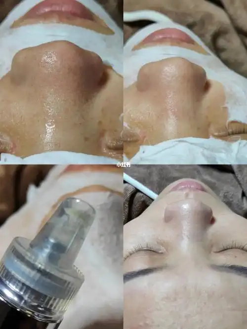 太原小气泡深层清洁补水