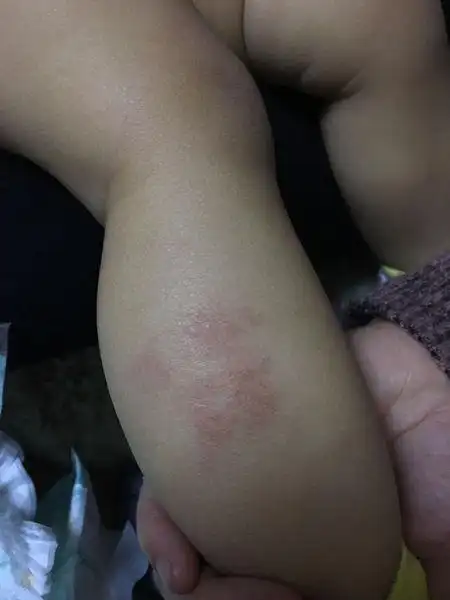 一岁多宝宝腿上有块地方发红很长时间了,像是癣,有知道的朋友吗