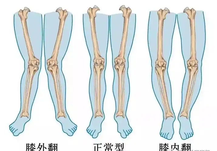 纠正x型腿o型腿避免运动损伤