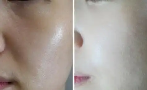 韩国高人气灰姑娘美白针效果好吗 美白针对比图片