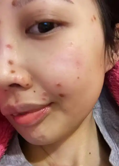 无力回天31岁香港女星抗癌九年病情恶化呼吸困难瘦成皮包骨