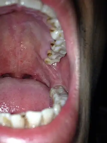 艾滋病舌头毛状白斑图片