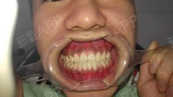 我是属于门牙内凹.下颚牙齿不齐