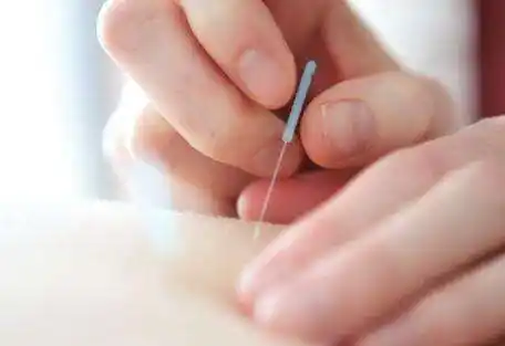 患者麻药过敏小小银针显威上海医生施行全球首例针刺麻醉下冠状动脉