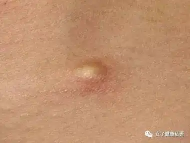女性下边长了一个硬硬的像痘的包