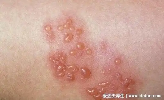 人体100种皮肤病对照图症状及名称,皮肤病种类及对应图片大片|健康