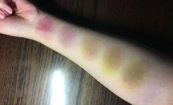 肝脏出现问题时的皮肤异常:发热,黄疸,皮肤瘙痒