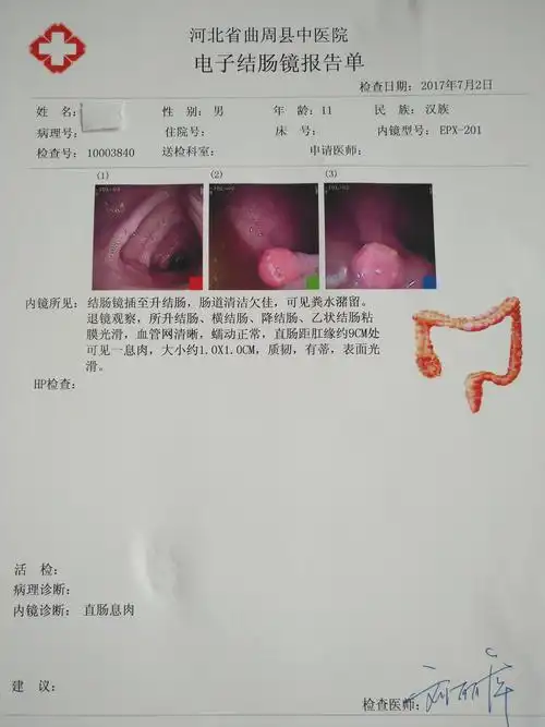 儿童便血,需警惕直肠息肉. - 好大夫在线