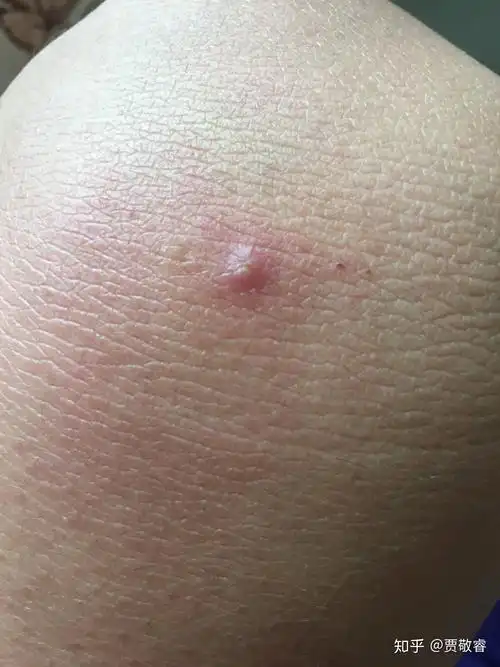 昨天被不明虫子咬了起了水泡戳破后一直在流毒水很痒怎么处理啊