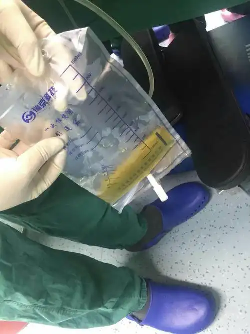 宿迁市儿童医院呼吸科完成闭式引流大量胸腔积液 支气管镜检查,灌洗