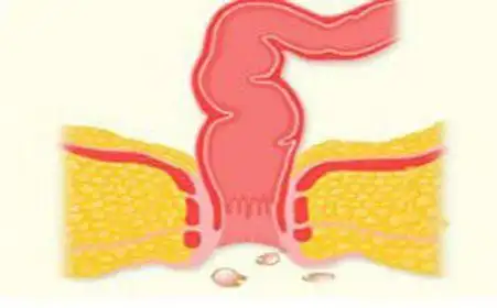 得了肛周湿疹哪里治疗