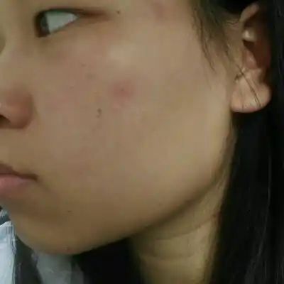 有没有宝妈脸上有红血丝的啊