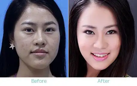 美白针对比案例