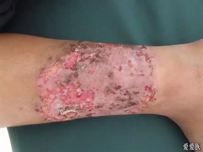 皮肤病胞子丝菌病治疗四天的变化