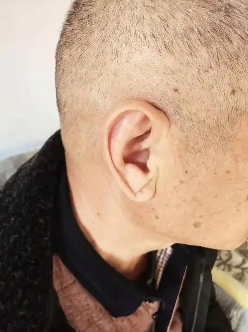 冠心病患者耳垂也会出现皱褶.