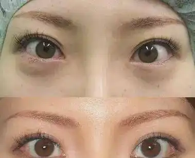 「医美科普」眼睑下至成形术!_手术