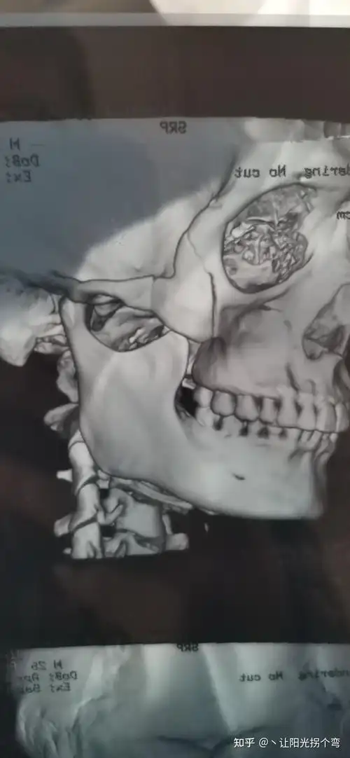 记录一次颧骨骨折