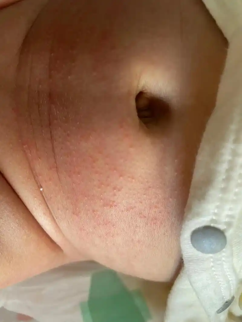 热痱子.#鸡娃  娃出生在特热的夏天,第一次养娃,什么都不懂 - 抖音