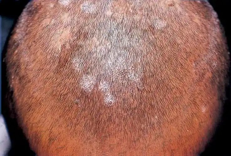 头癣黄白黑诊疗参考真菌感染头皮毛发所致