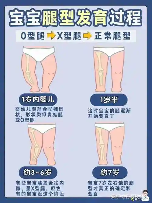 怎么样快速矫正o型腿