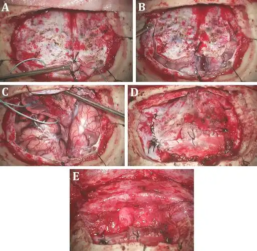 神外医师基本功--双额开颅术--the neurosurgical atlas系列