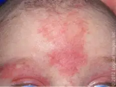 每年数以万计新生儿出现这种「红色胎记」,治疗要趁早