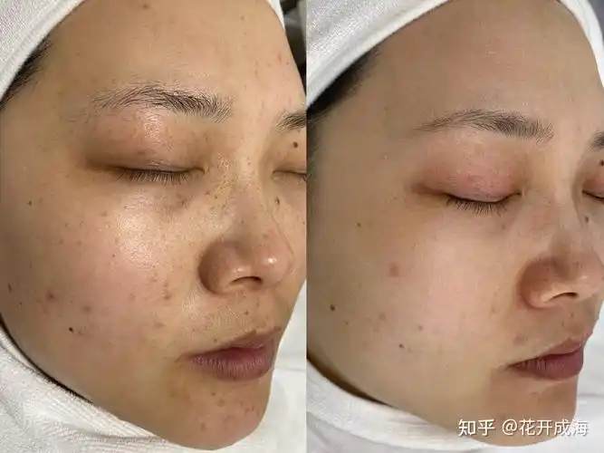 连续做一年光子嫩肤皮肤会有质的飞跃吗