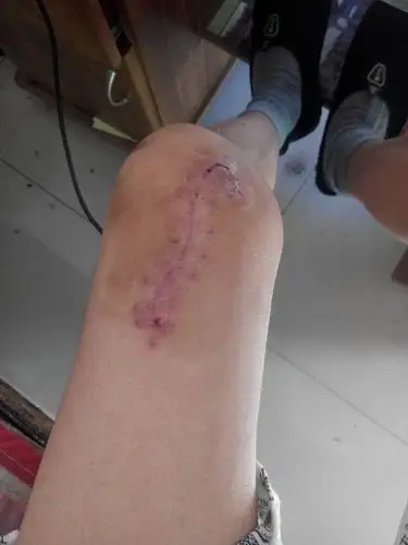 大腿用据割伤了在膝盖正上方缝了3层肌肉皮下组织和皮肤组织