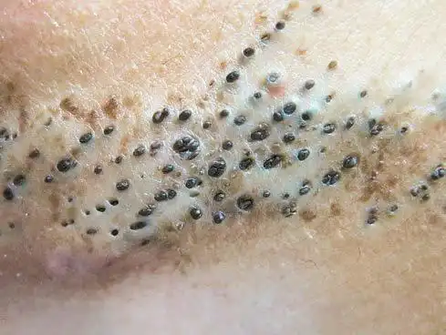 额头上长黑头粉刺怎么办