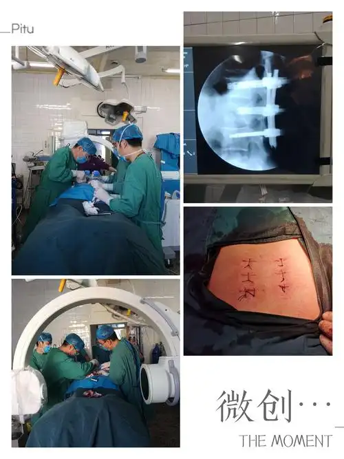微创经皮椎弓根螺钉内固定技术,让脊柱手术创伤最小.