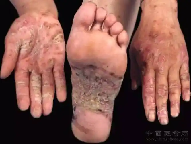 密集恐惧症及非医护人员慎点!史上最全的皮肤病图谱来了(修订版)!