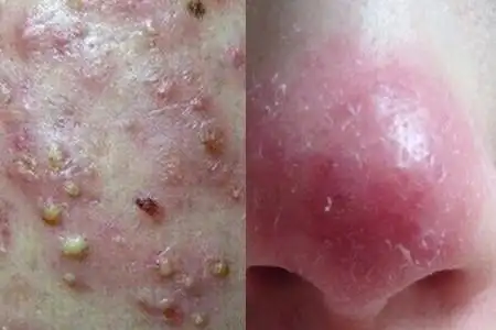 【图】怎样判断脸上有螨虫 若出现这几种状况就要小心