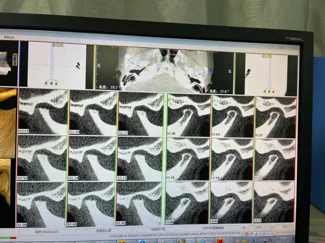 因为我还有下巴后缩及牙齿不正的问题,不知道该怎么办了,医生建议我先