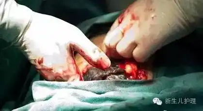 头,孩子的头终于露出来了孩子快出来了,护士提前准备好了氧气管儿快