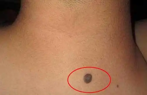 黑痣图片
