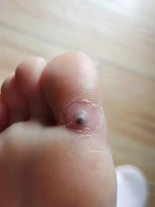 跖疣脱落过程 - 知乎