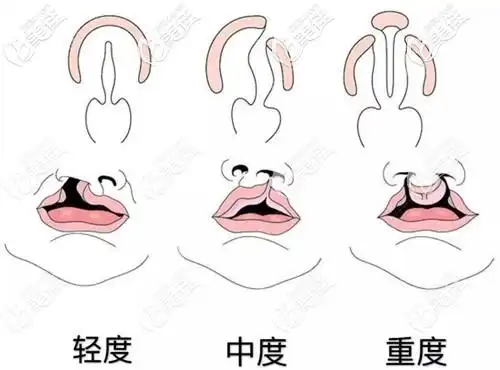 轻微隐形唇裂不做手术将来会后悔那么单侧轻度唇裂得做几次手术才会好