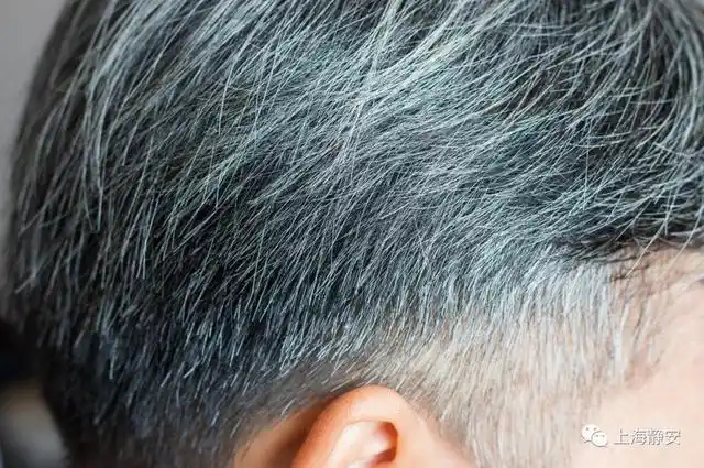 为什么压力大时会长白头发?"少白头"是怎么回事?