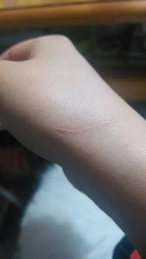 手上一道半年的疤还能去掉么