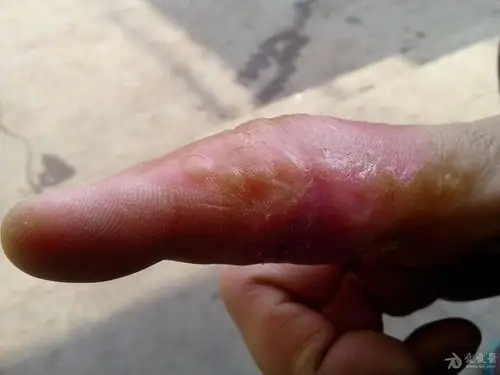 论坛 69 ★临床第三区 69 感染性与传染疾病专业讨论版 69 手指