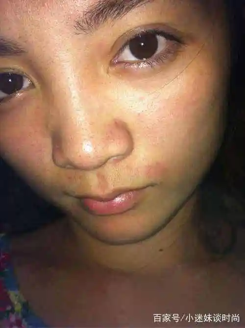 长期熬夜或睡眠不足会导致肝脏排毒功能障碍,造成脸色暗黄.